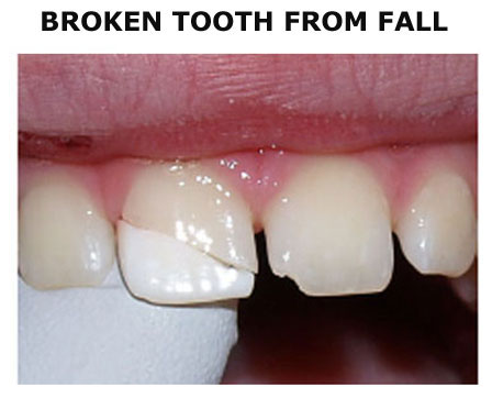 Broken-Tooth-From-Fall