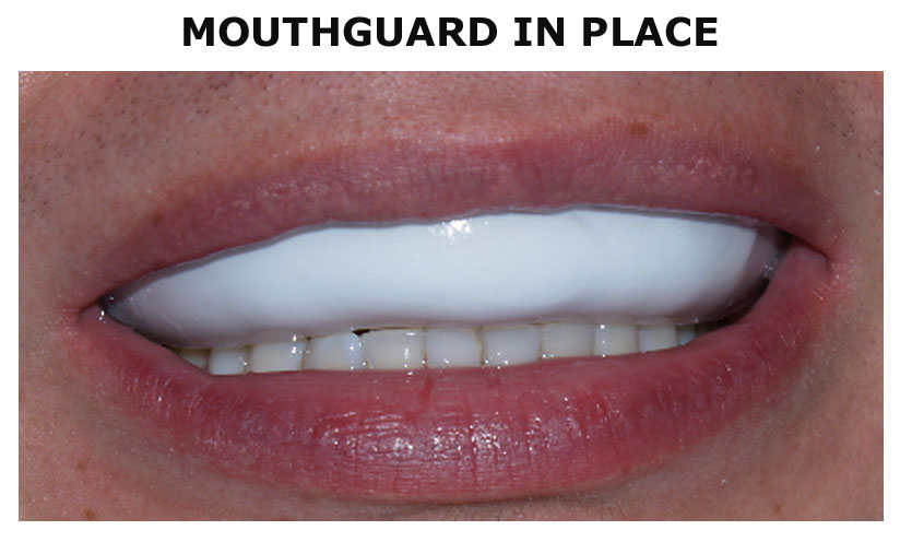 Mouth-Guard-In-Place